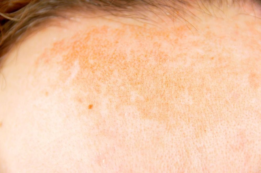 Sunspots On Skin Causes Symptoms Treatment And Prevention