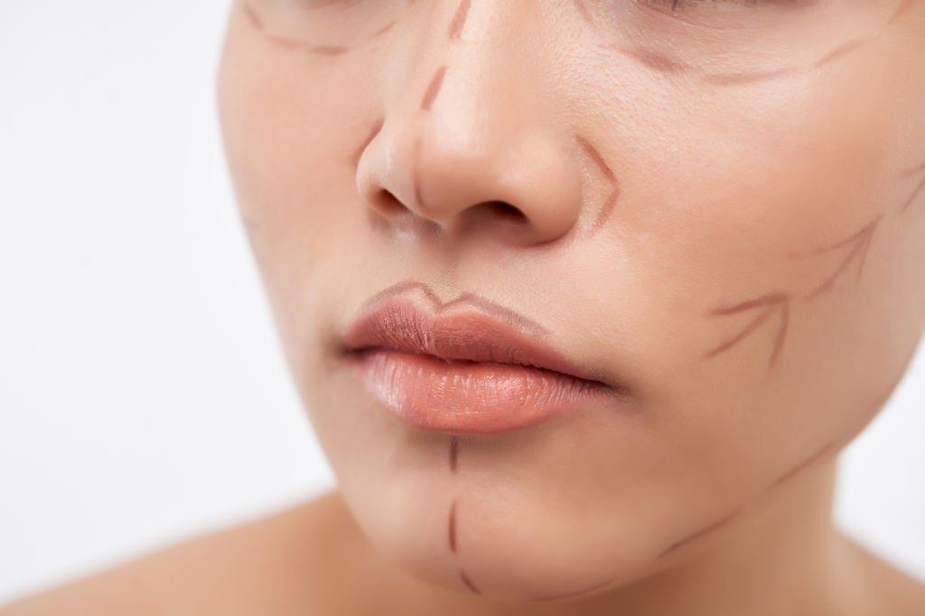 Facial Transformation: Facial Feminization Surgery Before & After